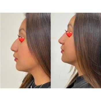 Swiss-made Hyaluronic Acid Nose Sculpture APPROVED BY FDA Swiss-made Hyaluronic Acid Nose Sculpture APPROVED BY FDA